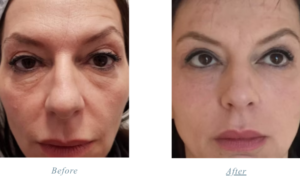 Attiva skin tightening and rejuvenation - before and after