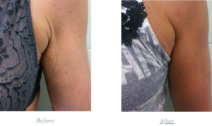 Attiva skin tightening and rejuvenation results