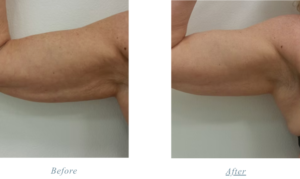 Before and after Attiva skin tightening and rejuvenation